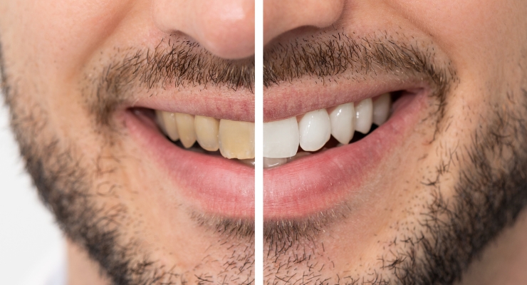 za-koga-su-ljuskice-za-zube