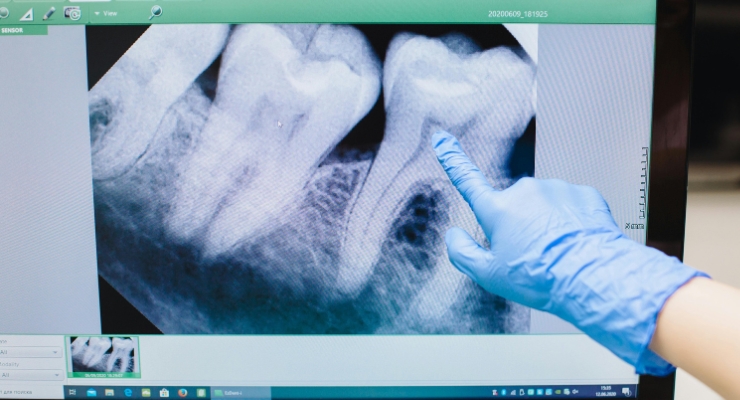 prvi-korak-u-liječenju-korijena-zuba
