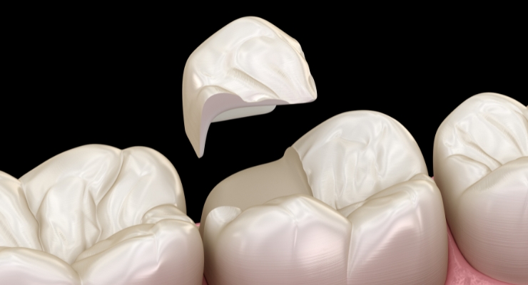 sto-napraviti-kad-pukne-zub