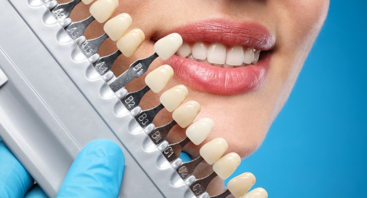 Koliko-traje-učinak-izbjeljivanja-zubi